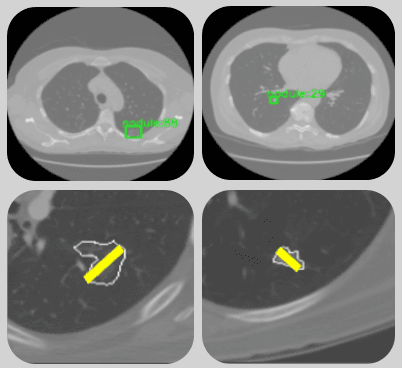 Auxílio ao diagnóstico de nódulo pulmonares
