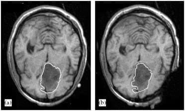 PSM (Patient-specific modeling) para exames de Tomografia do crânio 